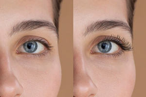 Upper and Lower Blepharoplasty image